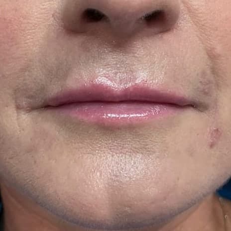 A client's lips from the front, natural in shape